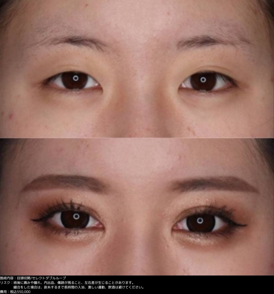 目頭切開 セレクトダブルループ 埋没法